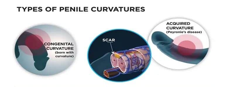Χειρουργική κάμψης πέους