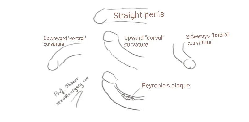 Χειρουργική κάμψης πέους Στην σελίδα Ανδρολογικές Παθήσεις θα βρείτε και άλλα άρθρα που σας ενδιαφέρουν. 📍 Εξωτερικά προφίλ ενημέρωσης: Για περισσότερες επιστημονικές πληροφορίες, βίντεο και ενημερωτικά θέματα χειρουργικής ανδΚάμψη πέους καμπυλότητα