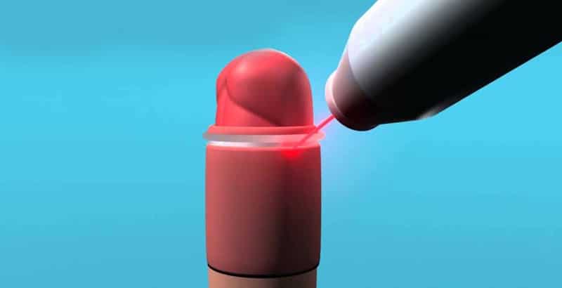 Φίμωση πέους περιτομή με Laser