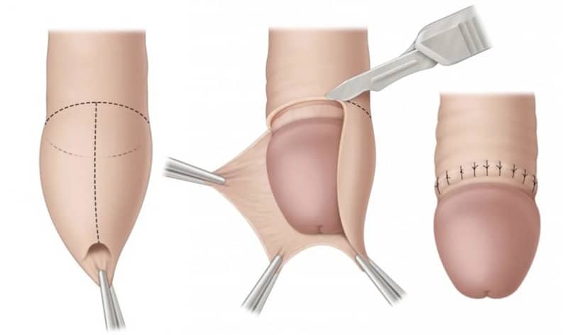 Φίμωση πέους περιτομή με Laser