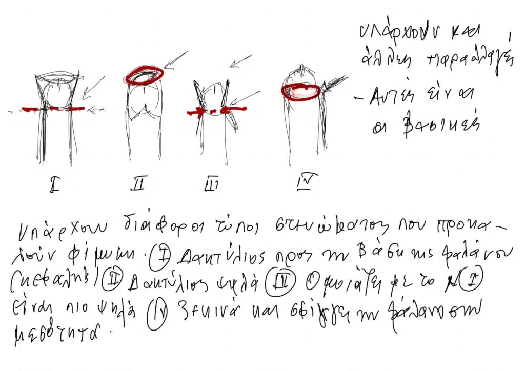 Φωτογραφίες Φίμωσης Περιτομής – τύποι στένωσης της ακροποσθίας, ενημερωτικό σκίτσο από ουρολόγο ανδρολόγο στη Θεσσαλονίκη.