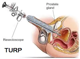 TURP-instrument