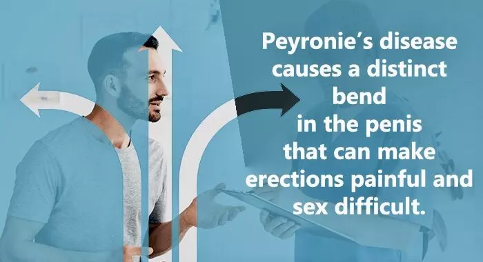 Νόσος Peyronie